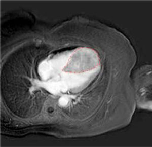 Cardiac CT scan imaging. The dotted line indicates a large lo-bate formation at the interventricular septum and cardiac apex, enhanced by the CT contrast medium.