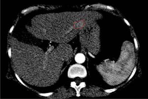 Liver CT scan imaging. The dotted line indicates a new nodular lesion at the III hepatic segment during the wash in of the portal phase.