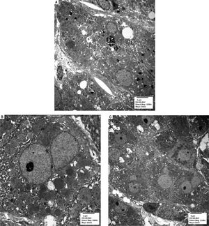 Electron microscopy images. A. Magnification (3200x): Cholestatic pigment and occasional lipid droplets. B. Magnification (6,500x): Increased and enlarged mitochondria. C. Magnification (2,100x): Prominent hepatic stellate cells.
