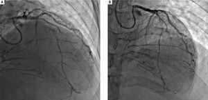Coronary angiogram images. A-B. Right and left anterior oblique cranial views, respectively, of the diffusely stenosed left anterior descending coronary artery, as compared with a relatively normal diagonal branch, and demonstrating significant collaterals that suggests an atretic right coronary artery.