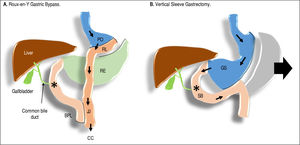 In the Roux-en-Y Gastric Bypass, the proximal stomach is divided to assemble a stomach pouch (PO) of about 30mL through which nutrient flow. The gastric remnant (RE) is not in contact with enteral nutrients any more, it is sealed proximally and in continuity with the duodenum distally. A segment of jejunum is connected to the stomach pouch forming to form the Roux limb (RL) of variable length (due to factors depending on surgeon and/or patient). The intestinal continuity must be guaranteed by connecting the biliopancreatic limb (BPL) to the Roux limb distally creating a jejunojejunostomy (JJ) which continues distally through the remaining bowel, i.e., the common channel (CC). In the Vertical Sleeve Gastrectomy, about 70% of the stoma ch is removed (arrow); a tube-like gastric sleeve (GS) is left, which is in continuity with an intact small bowel (SB). The result is a significantly decreased stomach volume. Symbols: arrows (→) indicate the nutrient flow. Asterisk (*) indicates the point of contact between bile, BAs, and nutrients.