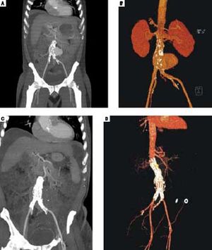 Angio-tomography with a ruptured confined aneurysm of the abdominal aorta with a hematoma (panel A and B). Follow-up angio-tomography after endovascular stent grafting (panel C and D).