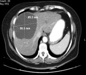 CT abdomen showing liver cyst 10 years prior.