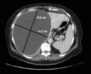 CT Abdomen on presentation showing huge liver cyst.