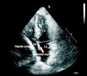 Echocardiogram on presentation showing right heart compression.