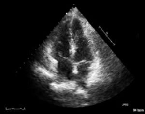 Post-operative echocardiogram showing resolution of compres sion.