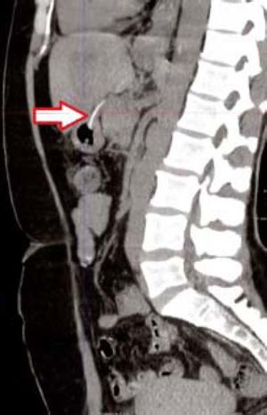Abdominal CT showing a foreign body perforating the lesser gastric curvature - Sagittal section.