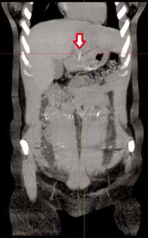 Abdominal CT showing a foreign body perforating the lesser gastric curvature - Coronal section.
