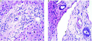 Chronic rejection. A. Fibrosis of the portal tract is seen. B. Bile duct senescence and portal fibrosis is seen in the above microphotograph (400x).