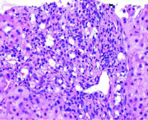 Extrahepatic biliary obstruction. Florid bile ductular proliferation accompanied by a neutrophilic infiltrate.