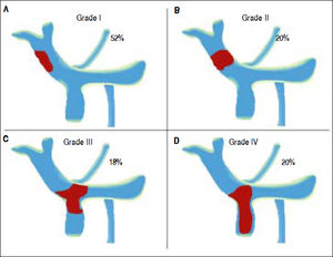 Yerdel Classification of Portal Vein Thrombosis. According to our results, fifty-cases had a thrombus in the portal vein or thrombosis in portal vein with invasion of mesenteric vein. The classification of Yerdel divides the portal vein thrombosis into 4 grades.10 Grade I: The thrombosis of portal vein affects < 50% of the vessel lumen. Grade II: Thrombosis affects more than 50% of the vessel lumen. Grades I and II could have minimal or no invasion of the superior mesenteric vein. Grade III: There is a complete obstruction of the portal vein and proximal invasion of superior mesenteric vein. Grade IV: The obstruction progressed to distal superior mesenteric vein.