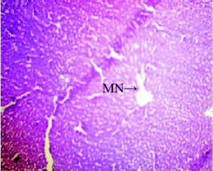 Microscopically photograph of liver section of Cisplatin + Aegle marmelos (2%) treated rats (Group - IV); Showing necrosis of the hepatic cells is mildly prevented H & E. MN: mild necrosis.