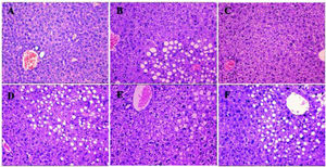 Liver H&E staining (200x) after treatment. More severe steatohepatitis was observed in HFD mice when HGF, c-Met, or JAK2 was inhibited. A. Control group. B-F. Different intervention groups as shown in figure. * P < 0.05, ** P < 0.01, *** P < 0.001 vs. group A (control);† P < 0.05, †† P < 0.01, ††† P < 0.001 vs. group B (HFD + normal saline); § P < 0.05, §§ P < 0.01, §§§ P < 0.001 vs. group C (HFD + HGF).