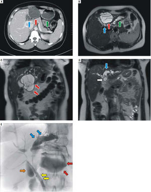 CT, MRI and cholangiography images. A. CT (contrast enhanced, transversal scan) and B. MRI (T2-weighted, transversal scan) -Cystoid multilocular formation in left hepatic lobe S4 (red arrow), with a dilation of the left intrahepatic bile ducts (blue arrow), in close proximity to the stomach (green arrow). C,D. MRI (T2-weighted, coronal scan) showing the same multilocular formation in left hepatic lobe S4 (red arrows), with a dilation of the left intrahepatic bile ducts (blue arrow) and intraluminal tumor masses (white arrow). E. Percutaneous transhepatic cholangiography and drainage - dilation of the left intrahepatic bile ducts (blue arrows), with irregular stenosis centrally and narrow common bile duct (yellow arrows); contrast is also visible in the cystoid formation (red arrows) and the gallbladder (orange arrow).