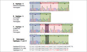 Electropherograms showing the results of sequencing for the region of interest (the region of 157insMTTTVP) in exon 4 of the HAVCR1 gene in persons who were homozygous for the three haplotypes (Panel A: homozygous for reference sequence [haplotype C]; Panel B: homozygous for a 15-nucleotide (nt) deletion [haplotype A]; Panel C: homozygous for a 3-nt insertion [haplotype B]). Panel D shows the electropherogram for a subject who was heterozygous for haplotypes A and B; the panel below this electropherogram shows the sequences for the two haplotypes and the expected merged sequence (the ambiguous codes are represented as per the notation laid down by the International Union of Pure and Applied Chemistry).