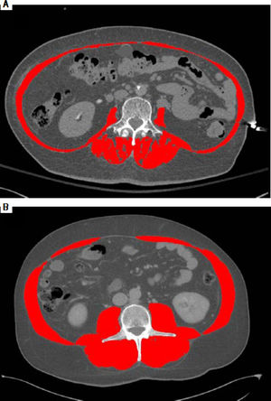 Sarcopenia determined by cross-sectional imaging. Patient of figure 1A had sarcopenia, with a BMI 32 kg/m2 and L3 SMI of 50 cm2/m2. Patient of figure 2B did not have sarcopenia, with the same BMI of 32 kg/m2 but a L3 SMI of 70 cm2/m2.