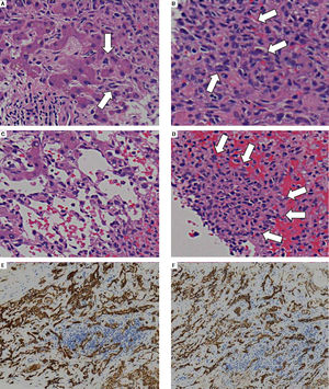 A.Areas with mild tumor cell invasion show dilated hepatic sinusoids lined by hypertrophied endothelial cells with atypical hyperchromatic nuclei (arrows). B and C. With progressive involvement, the sinusoids dilate and fill with malignant endothelial cells (B, arrows) with liver cell plate atrophy (C). D. Areas in which hepatocytes have entirely disappeared sometimes exhibit solid malignant cell growth (arrows). E and F. Immunohistochemical analysis. The tumor cells are positive for the endothelial markers CD31 (E) and CD34 (F).
