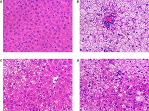 Histopathological changes in liver tissues of rats in various study groups. A, B, C and D are representative images from control, model, SC formula and rosiglitazone groups (400 x).