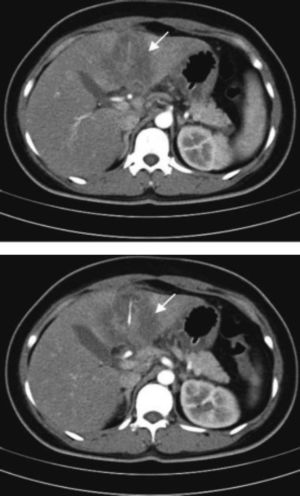 Contrast-enhanced computed tomography (CT) of the upper abdomen revealed a left-sided solid liver abscess, with a straight, hyperdense feature ~3.0 cm long at the centre, and gastric wall thickening at the antrum (white arrow).