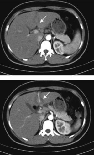 Repeat contrast-enhanced CT scan of the upper abdomen revealed that the left-sided liver abscess had narrowed after treatment, but the straight, hyperdense feature at the centre of the liver abscess remained.