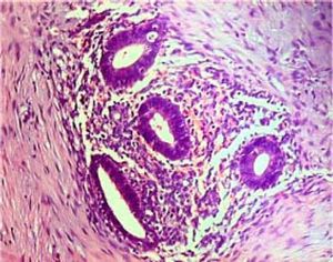 Small endometrial glands embedded on the stroma of one of the endometriotic foci (HE, x100).