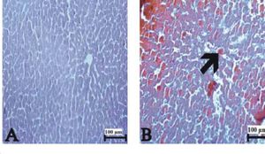The liver sections stained with Congo red. (A) Control rat liver, (B) amyloid deposits in liver of 500 μmg/kg Thymol + Indo treated rats. [Arrow: amyloid accumulation]. Bars: 100 μm.