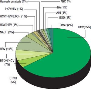Distribution of etiologies of liver disease in 145 patients who underwent liver transplant for hepatocellular carcinoma at the Johns Hopkins University Comprehensive Liver Transplant Center, expressed in percentages. HCV: hepatitis C virus. ETOH: Alcoholic liver disease. HBV: hepatitis B virus. NASH: non-alcoholic steatohepatitis. HIV: human immunodeficiency virus. PBC: primary biliary cholangitis. BA: biliary atresia. AIH: autoimmune hepatitis. GSD: glycogen storage disease.