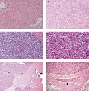 Pathology description. A. Normal liver 20x. B. Well differentiated HCC 10x. C. Moderately differentiated HCC 10x. D. Poorly differentiated HCC 20x. E. Histology of TACE treated hepatocellular carcinoma demonstrating regions of cirrhotic liver (Ci), viable hepatocellular carcinoma (HCC), fibrosis (Fi) and tumor necrosis (Nec). Arrows show collections of embolic beads. F. Microvascular invasion. Arrow illustrates the tumor cells inside the vessel.
