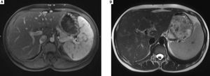 A. MRI images: recanaiization of para-umbiiicai vein (January 2016). B. MRI images: splenomegaly (January 2016).
