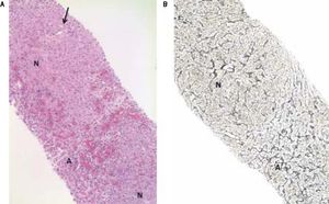 A. Needle liver biopsy specimen showing abnormal parenchymal pattern with alternating nodular foci (N) without cirrhosis and atrophic foci (A) with blood-filled spaces at the place of thin liver cell plates and altered sinusoids. Note the non fibrotic portal tract (arrow) in the center of the upper nodule (HES, objective × 10). B. Hyperplastic parenchymal nodule (N) with thickened liver cell plates perpendicularly arranged to the atrophic hepatocellular foci (A) (Reticulin, objective × 10).