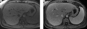 A.MRI images: development of liver metastases (T1 fat-sat, March 2016). B. MRI images: development of liver metastases (T1 fat-sat gadolinium, March 2016).
