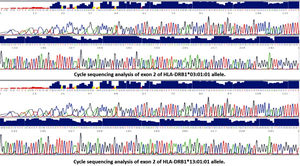 Cycle sequencing analysis of exon 2 of HLA-DRB1*:03:01:01 & HLA-DRB1*:13:01:01alleles.