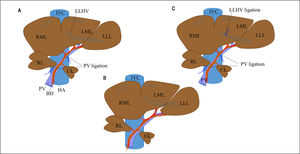 Surgical procedure for PVL and in PVL with venous congestion (PVL + C) rat models. For PVL (A), PVL is performed for the right and left middle lobes, left lateral lobe, and right lobe. For PVL + C (B), the same PVL procedure is performed followed by induction of venous congestion by ligating the left lateral hepatic vein. The preoperative rat liver anatomy is shown in panel C (sham operation). PVL: portal vein ligation. CL: caudate lobe. RML: right middle lobe. LML: left middle lobe. LLL: left lateral lobe. PV: portal vein. IVC: inferior vena cava. HA: hepatic artery. LLHV: left lateral hepatic vein.