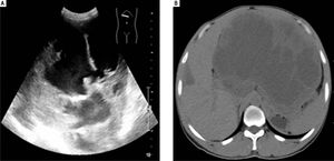 Ultrasound examination (A) revealed a mixed echo mass within the left lobe of the liver and the tumor was too large to be measured by this method. Computerized tomography examination (B) revealed a large mass approximately 21.0 cm x 16.0 cm with a mixed density and an irregular border in the left hepatic lobe.