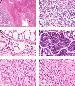Figure 2. Microscopic features of primary hepatic adenoid cystic carcinoma. There is a thick capsule between the tumor (left lower) and the adjacent liver tissue (right upper, A, 20x). The predominant growth pattern of this tumor is cribriform (B, 100x). The cystic spaces within the cribriform area are predominantly pseudocysts filled with loose myxoid material (B, 100x) and eosinophilic base membrane-like material (C, 200x) but there are occasional true small glands (C, 200x). This tumor contains only focal solid growth (D, 200x) and tubular structures (E, 200x). There is abundant hyalinization in the stroma in some areas which compressed the tumor cells into anastomosing strands (F, 200x).