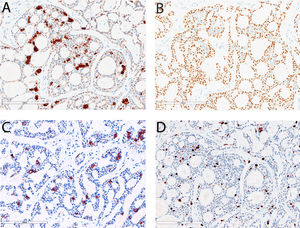 Immunohistochemical staining results of primary hepatic adenoid cystic carcinoma. Cytokeratin 7 is diffusely positive in the tumor cells and shows stronger staining in the luminal cells than abluminal cells (A, 200x). P63 staining labels abluminal cells but not luminal cells (B, 200x). CD117 staining labels luminal cells but not abluminal cells (C, 200x). The Ki-67proliferation index in this tumor is about 10-15% (D, 200x).