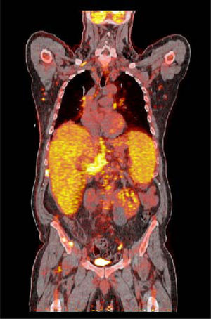 Whole body PET-scan. A PET showed increased uptake at supra and infradiaphragmatic adenopathies, liver, spleen, as well as a pulmonary nodule with centra cavity.