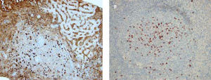 Pathology. A liver (A) and axilar lymph node (B) biopsy showed an intense limphoplasmocitary inflammatory infiltrate with an increased number of plasmatic cells, eosinophils, and an increased IgG4 + cell/IgG + cell ratio (74 and 65%, respectively).