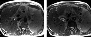 Magnetic resonance cholangiopancreatography. T2-weighted images of baseline (A) and control (B) MRCP showed marked worsening of the diffuse bile duct thickening, i.e. at the common bile duct (white arrows).