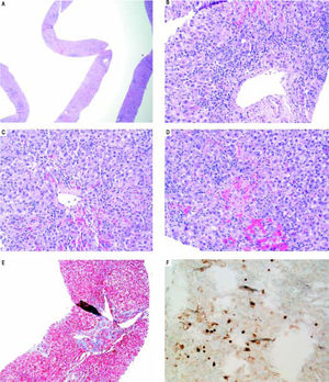 Liver biopsy. A. Low power view showing active hepatitis with disarray and inflammation. B. Portal tract with mixed infiltrate, interface activity and hepatocyte injury (swelling and apoptosis), C-D. Lobular activity and pericentral inflammation with hepatocyte dropout, hemorrhage, and cholestasis. Plasma cells are present. E. Trichrome stain showing mild porta fibrosis. F. Hepatitis B core antigen stain with nuclear staining and significant focal cytoplasmic staining.