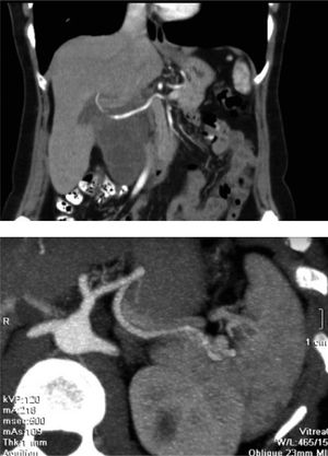 Coronal abdominal contrast computed tomography image and vascular reconstruction. The hepatic artery, originating from the celiac trunk, pass through the lesion without infiltration sings.