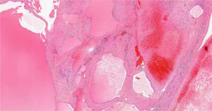Hematoxylin eosin stained of the hepatic mass section: the tumor is composed of fusiform cells delimitating vascular spaces, with arteries and veins of different shapes. Necrosis and hemorragic areas with hemosiderophages can be observed.