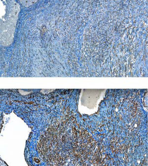 Immunohistochemistry expression of mesenchymal cells interposed between vascular spaces: actin expression (upper figure) and same cells positive for caldesmon expression (lower figure).