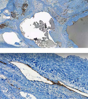 Immunohistochemistry expression of the cells involving the vascular spaces: CD 31 expression (upper figure) and CD 34 expression (lower figure).