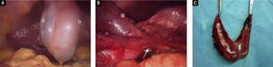 Intraoperative view of a duplicated gallbladder (a and b), and the main cystic duct (arrow). C. Specimen of Y-shaped duplicated gallbladders within a common serosal coat each with a cystic duct (arrows). Clips can be seen on either side of the V-shaped ducts.