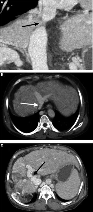 Preoperative CT images. A. CT-angiography reveals a membranous obstruction of the intrahepatic IVC (arrow). B. Axial porta venous phase CT scan reveals that the right HV cannot be visualized; the co-orifice of the middle HV and left HV have a membranous obstruction; and the azygos and hemiazygos veins are markedly dilated (arrow). C. Axial porta venous phase CT scan reveals a side-to-side anastomosis (arrow) between the portal vein and IVC, a finding compatible with type II Abernethy malformation.
