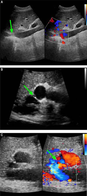 Preoperative Doppler ultrasound images. A. Abdominal two-dimensional ultrasound and three-dimensional Doppler ultrasound images reveal a membranous obstruction of the intrahepatic IVC without blood flow (arrow). B. Abdominal two-dimensional ultrasound and Doppler ultrasound images reveal that the co-orifice of the middle HV and the left HV have a membranous obstruction and no blood flow, C. Abdominal two-dimensiona ultrasound and Doppler ultrasound images reveal an abnormal connection (arrow) between the porta vein and the IVC.