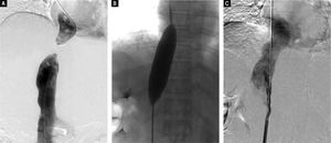 Digital subtraction angiography images. A. Inferior vena cavogram via both the jugular approach and the femoral approach reveal complete obstruction of the intrahepatic IVC, which confirmed the results of Doppler ultrasound and CT-angiography. B. Dilation of the obstructed IVC with a 25 mm diameter balloon after successful rupture of the membrane, C. Inferior vena cavogram immediately after balloon angioplasty reveals patency of the IVC without residua stenosis.