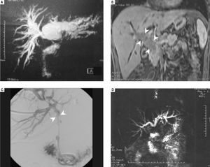 Patient 1: MR T2-weighted showing an important biliary tree dilatation, mostly in left duct. B. Patient 2: MRI image showing an infiltrative mass inside the hepatocholedocus (arrow heads), C. Patient 3: Percutaneous cholangiography during biliary drain placement. Main duct blockage is evidenced (arrow heads). D. Patient 4: MR T2-weighted showing obstruction of common bile duct with upstream dilatation.