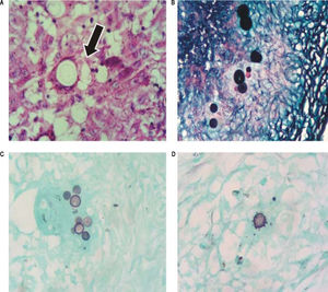 Patient 1: area of granuloma containing fungal spherical elements (arrow) compatible with P. brasiliensis, H&E stain x400. B. Patient 2: fungal structures with budding affecting lymph node, Grocott’s methenamine silver stain x400. C and D. Patient 3 and 4: fungal structure with characteristic “Mickey Mouse” and “steering wheel” budding, respectively, Grocott’s methenamine silver stain x400.